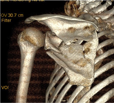 Glenoid Displacement CT